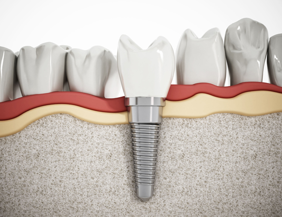 What Are Dental Implants