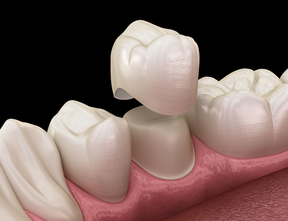 Who Is A Good Candidate For Dental Crowns