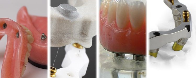 Types Of Attachments For Dental Prostheses On Implants